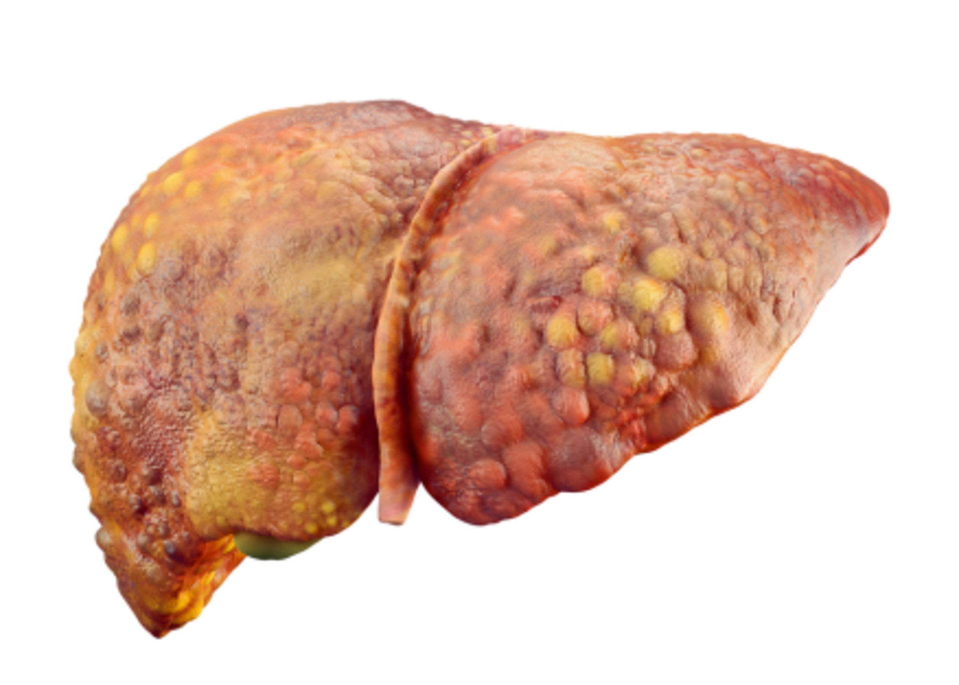 Alcoholic liver disorder